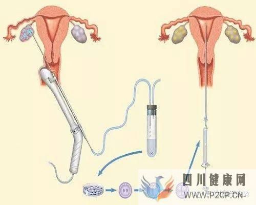 試管嬰兒的一個(gè)基本流程和周期時(shí)間(二代試管嬰兒需要多長時(shí)間)(圖4) 試管嬰兒的一個(gè)基本流程和周期時(shí)間(二代試管嬰兒需要多長時(shí)間)(圖4)