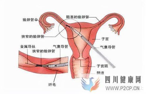 輸卵管阻塞何時可以做試管嬰兒(女方輸卵管堵塞做試管嬰兒需要多長時間)(圖1)